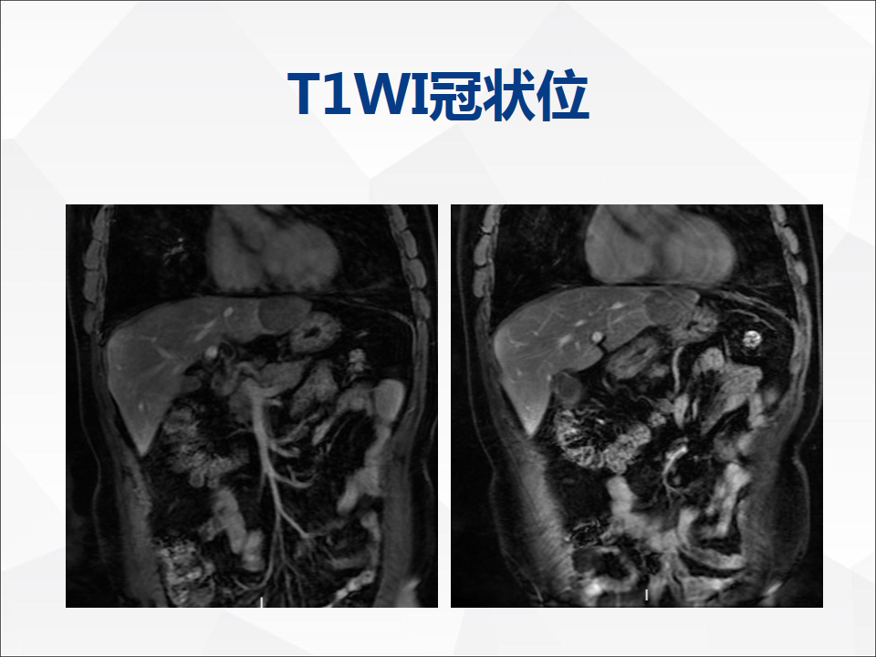 影像PPT - 【病例】肝脏神经内分泌肿瘤1例CT及MR-13