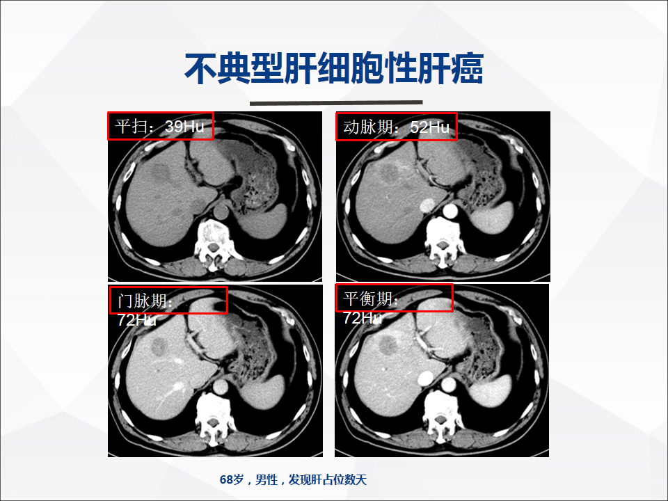 影像PPT - 【病例】肝脏神经内分泌肿瘤1例CT及MR-23
