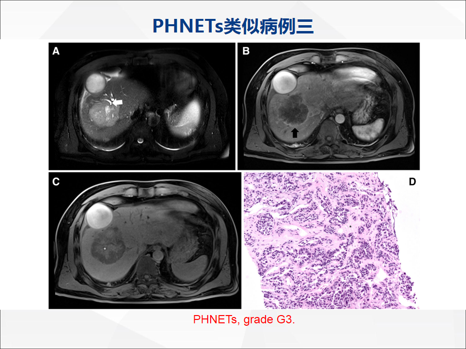 影像PPT - 【病例】肝脏神经内分泌肿瘤1例CT及MR-35
