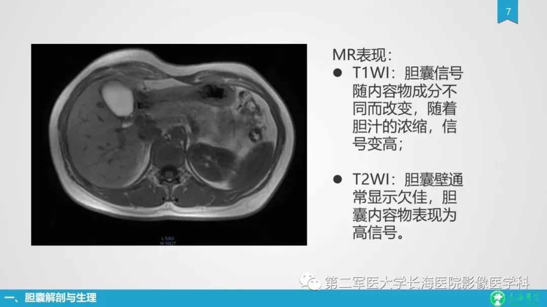 影像PPT - 【PPT】胆囊良性病变及其影像学特征-7