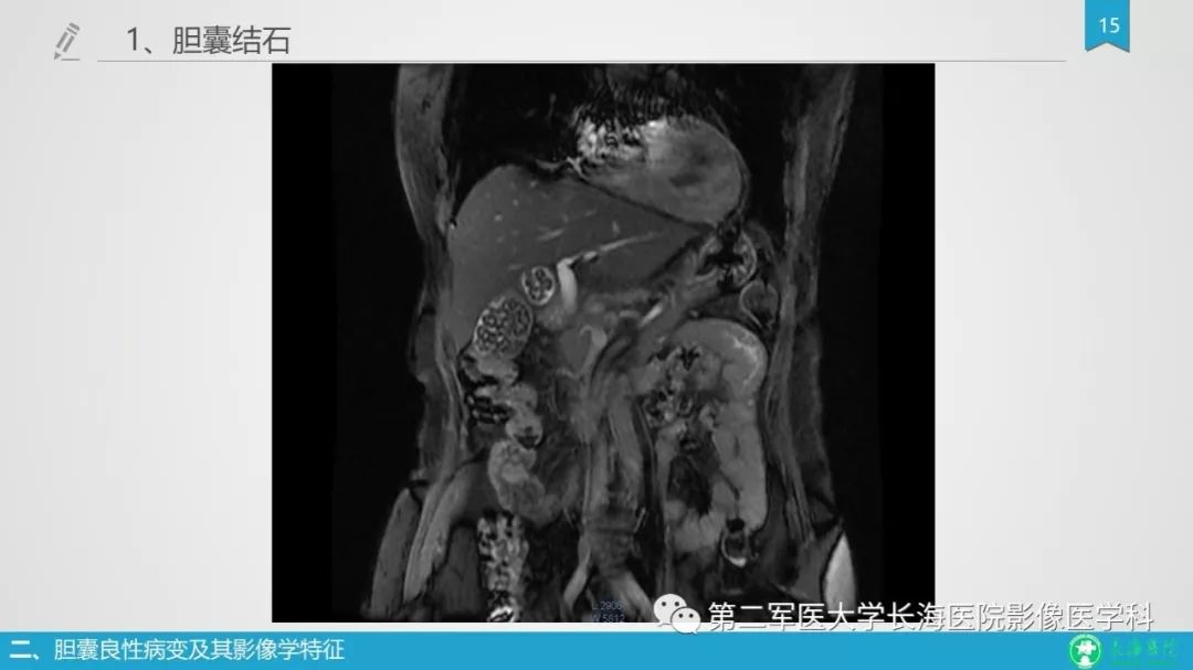 影像PPT - 【PPT】胆囊良性病变及其影像学特征-15