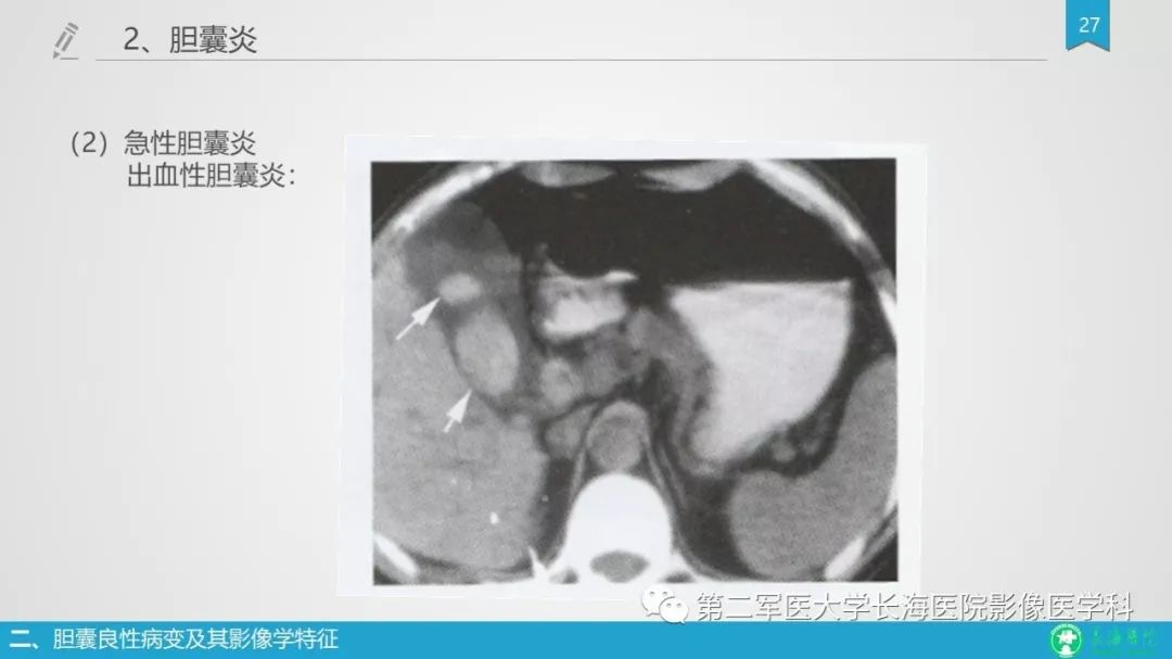 影像PPT - 【PPT】胆囊良性病变及其影像学特征-26