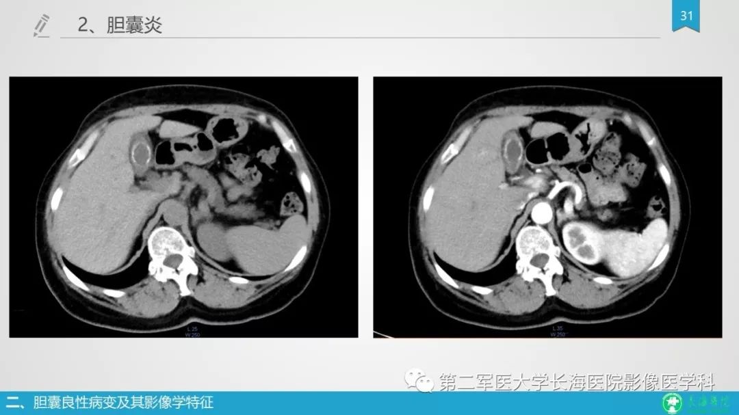 影像PPT - 【PPT】胆囊良性病变及其影像学特征-30