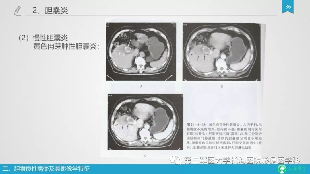 影像PPT - 【PPT】胆囊良性病变及其影像学特征-35