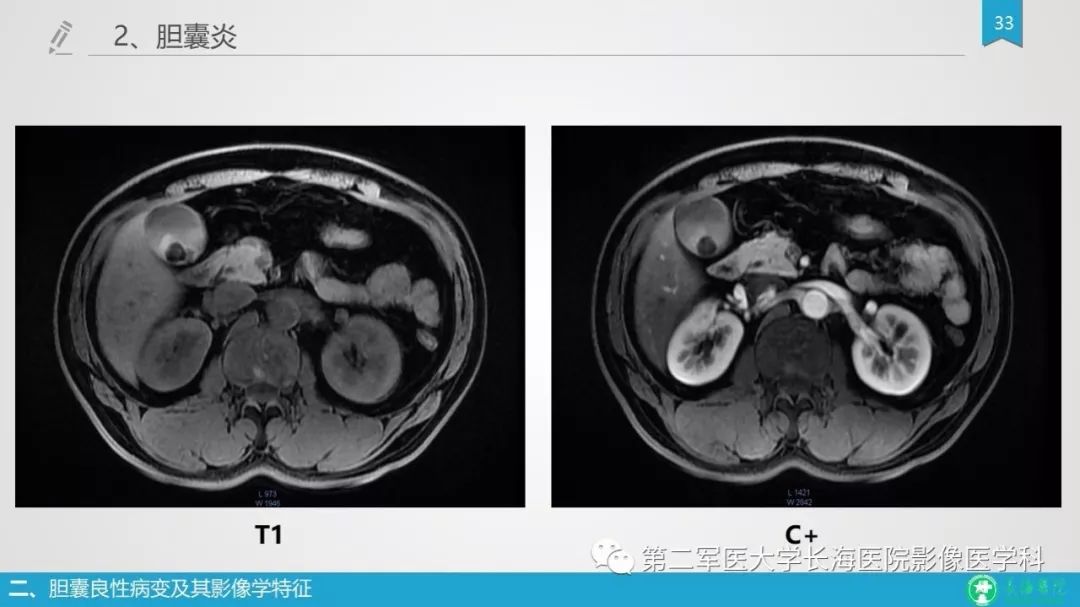 影像PPT - 【PPT】胆囊良性病变及其影像学特征-32
