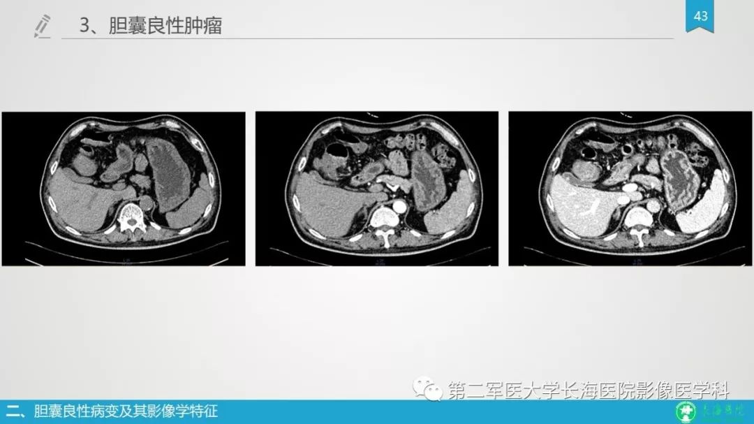 影像PPT - 【PPT】胆囊良性病变及其影像学特征-42