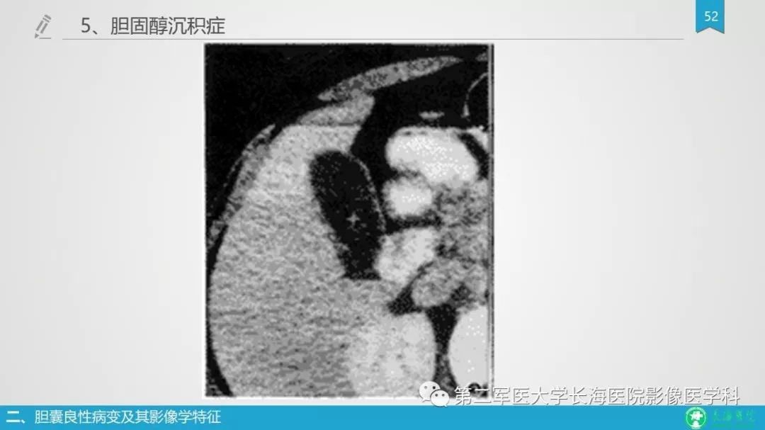 影像PPT - 【PPT】胆囊良性病变及其影像学特征-51
