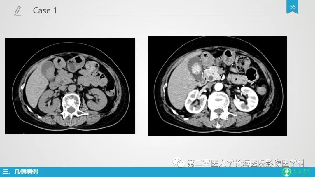 影像PPT - 【PPT】胆囊良性病变及其影像学特征-54