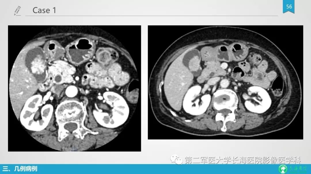 影像PPT - 【PPT】胆囊良性病变及其影像学特征-55