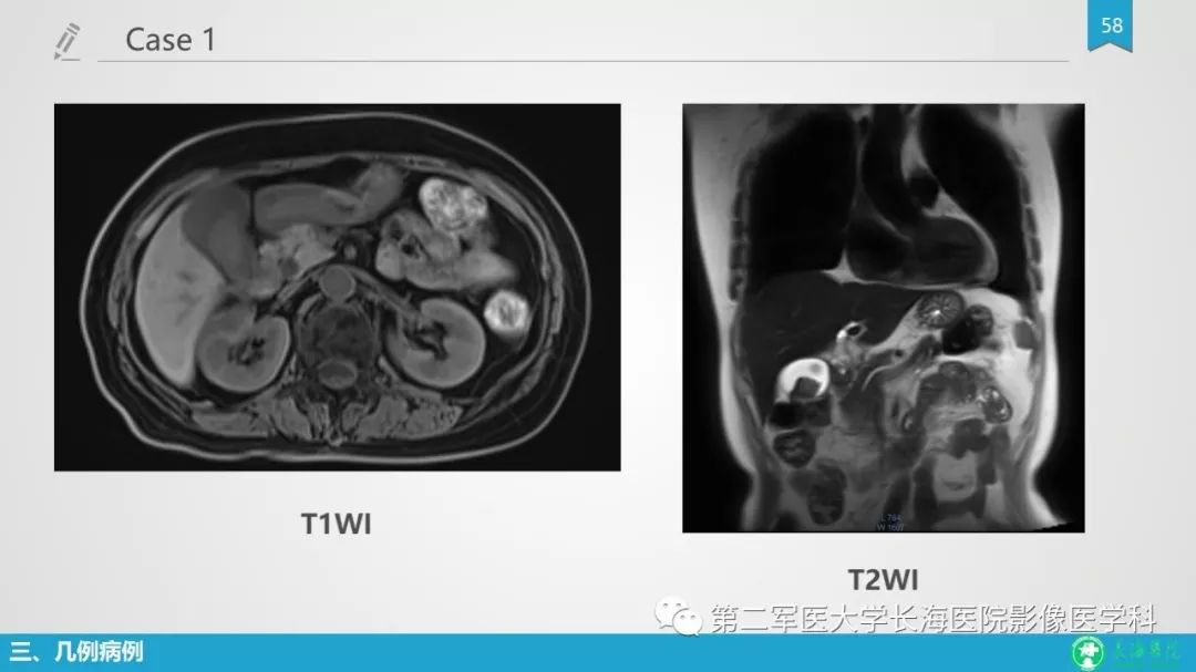 影像PPT - 【PPT】胆囊良性病变及其影像学特征-57