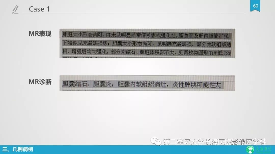 影像PPT - 【PPT】胆囊良性病变及其影像学特征-59