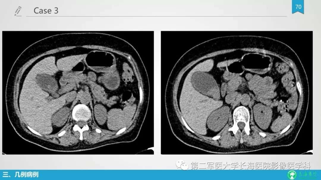 影像PPT - 【PPT】胆囊良性病变及其影像学特征-69
