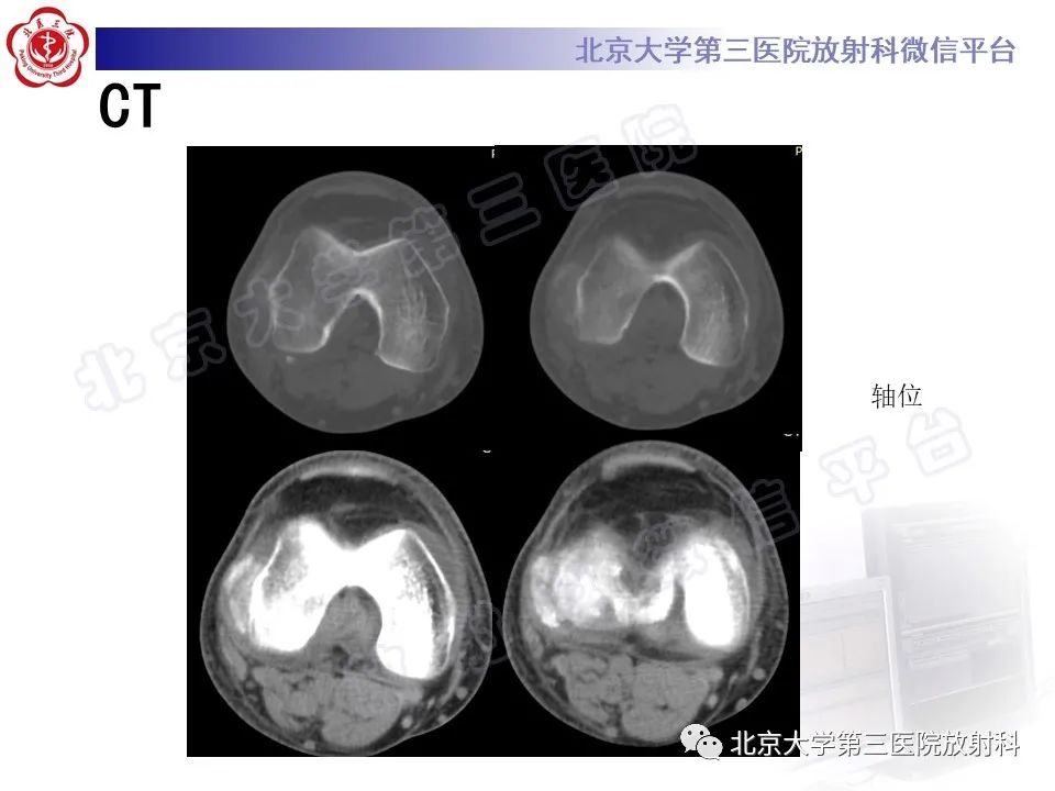 影像PPT - 【PPT】痛风-3