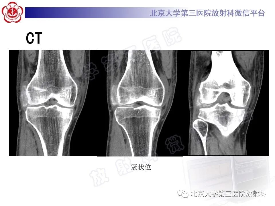 影像PPT - 【PPT】痛风-4