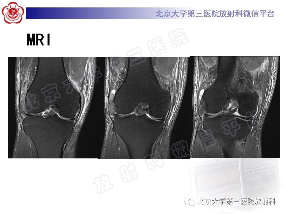 影像PPT - 【PPT】痛风-5