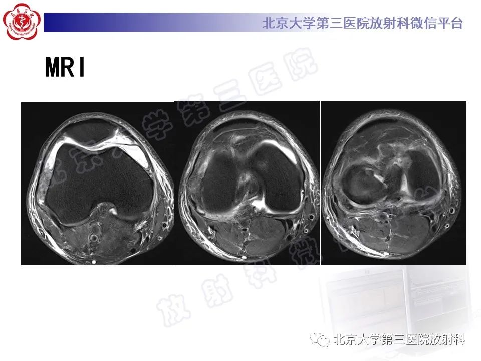 影像PPT - 【PPT】痛风-6