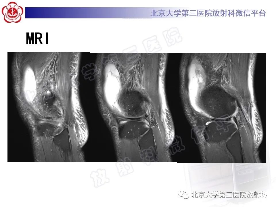 影像PPT - 【PPT】痛风-7