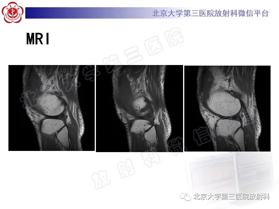 影像PPT - 【PPT】痛风-8