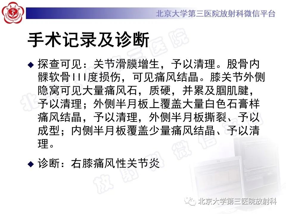 影像PPT - 【PPT】痛风-12