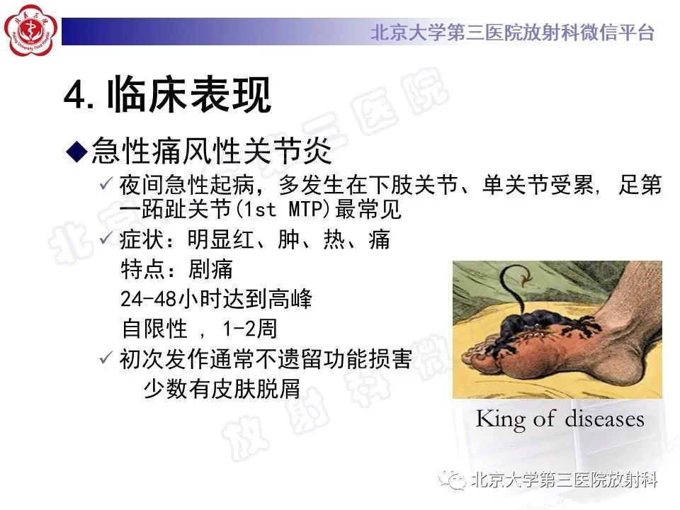 影像PPT - 【PPT】痛风-18