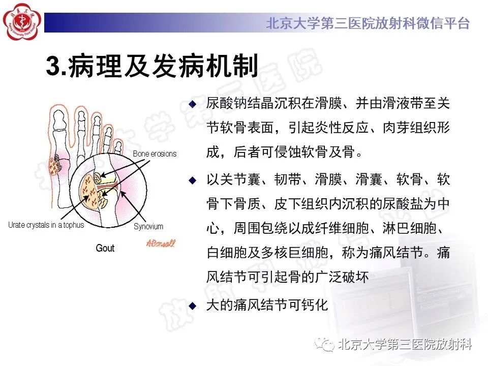 影像PPT - 【PPT】痛风-17