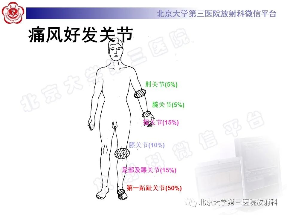 影像PPT - 【PPT】痛风-20