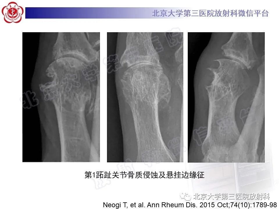 影像PPT - 【PPT】痛风-24