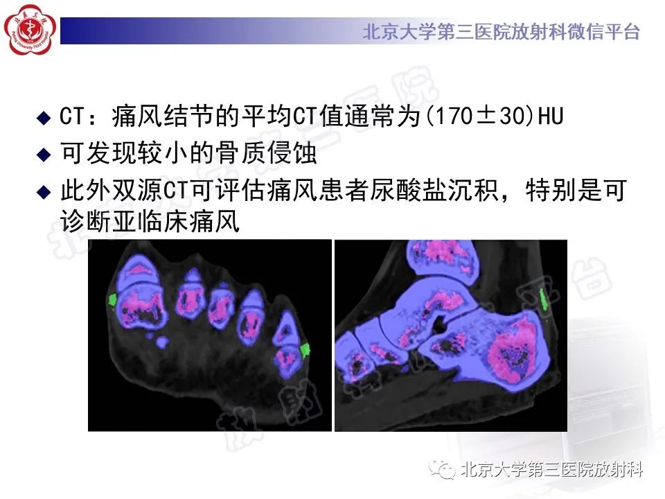 影像PPT - 【PPT】痛风-25