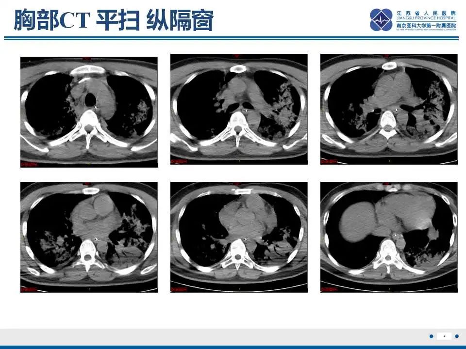 影像PPT - 【PPT】鹦鹉热衣原体肺炎-5