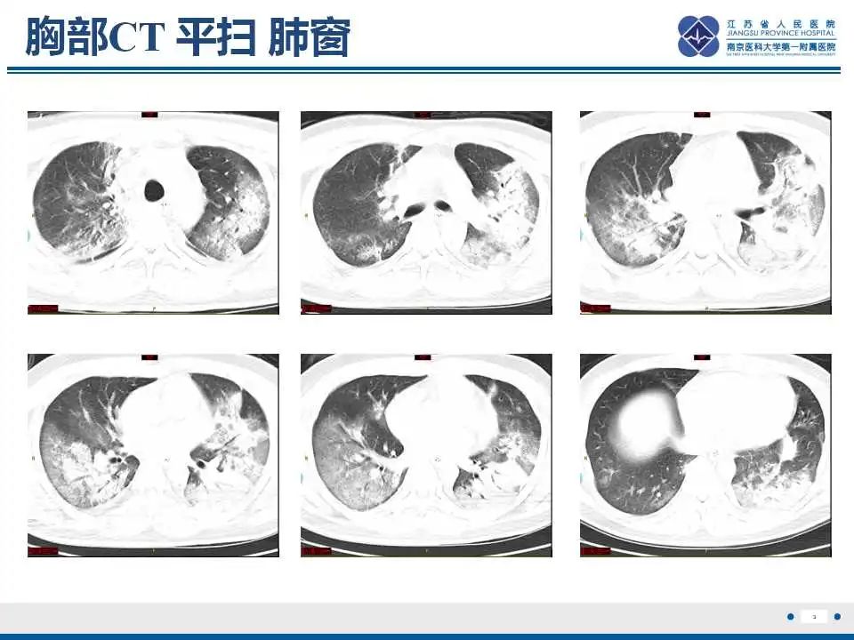 影像PPT - 【PPT】鹦鹉热衣原体肺炎-4