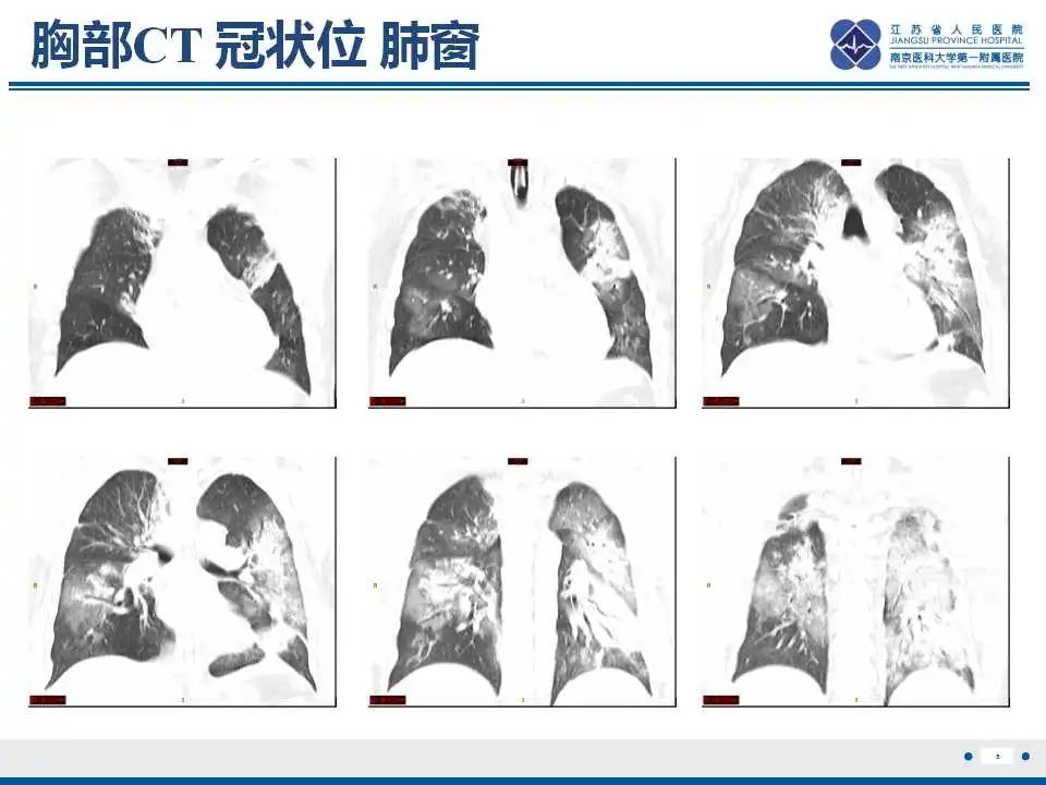 影像PPT - 【PPT】鹦鹉热衣原体肺炎-6