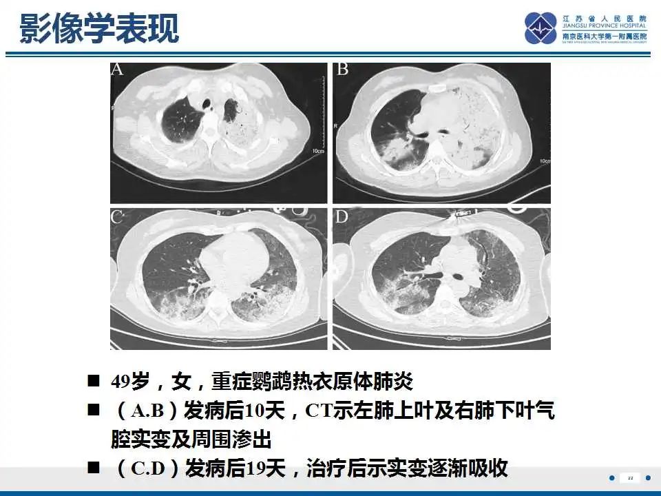 影像PPT - 【PPT】鹦鹉热衣原体肺炎-23