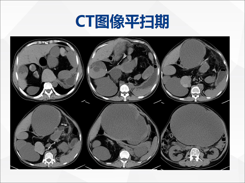 影像PPT - 【病例】腹腔成熟型畸胎瘤合并腹膜胶质瘤病1例CT-3