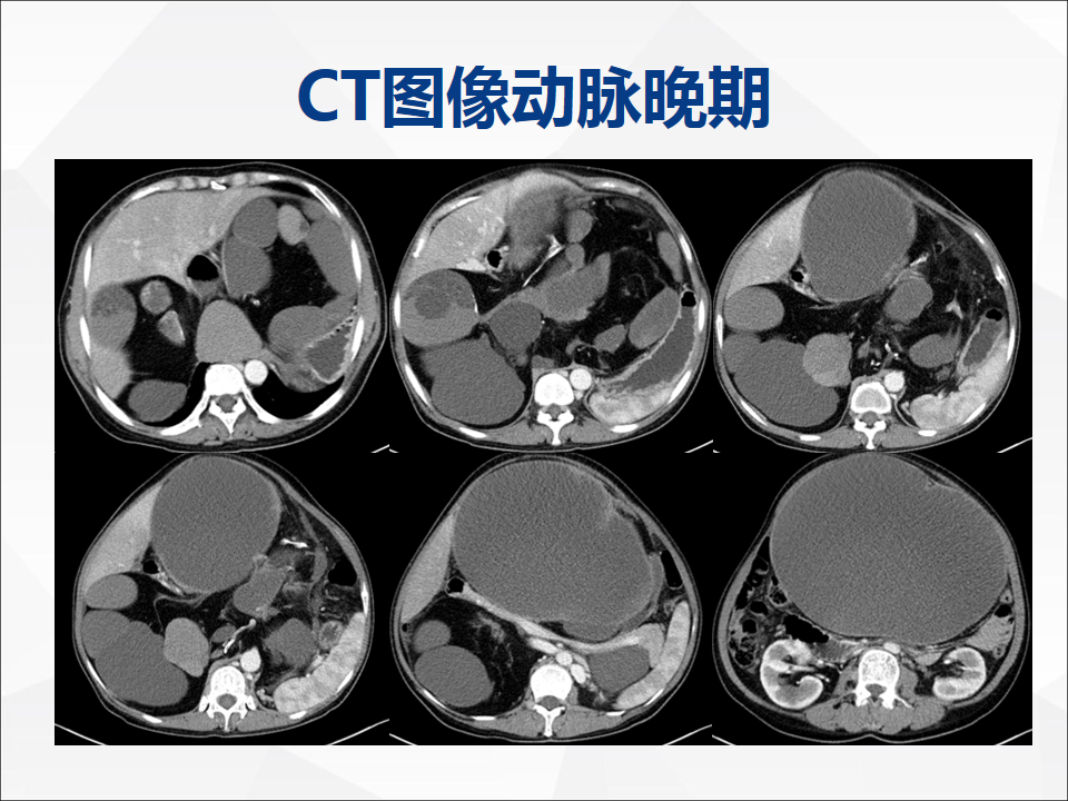 影像PPT - 【病例】腹腔成熟型畸胎瘤合并腹膜胶质瘤病1例CT-4