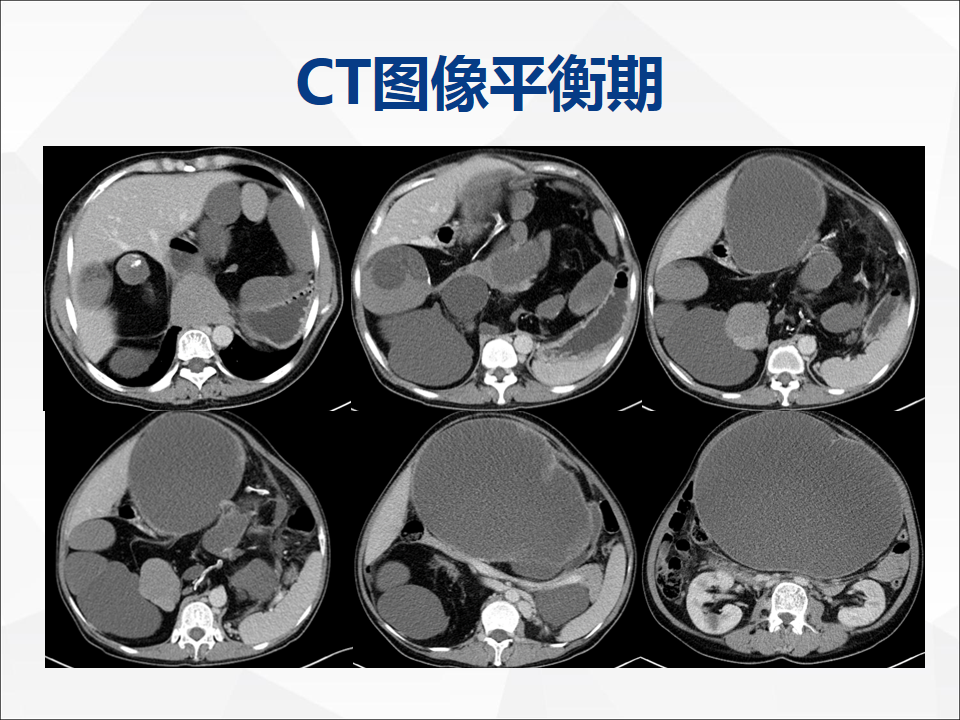 影像PPT - 【病例】腹腔成熟型畸胎瘤合并腹膜胶质瘤病1例CT-5