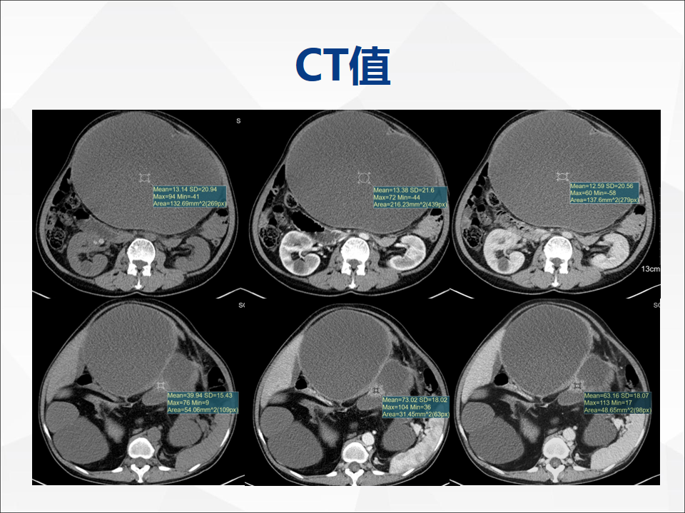 影像PPT - 【病例】腹腔成熟型畸胎瘤合并腹膜胶质瘤病1例CT-7