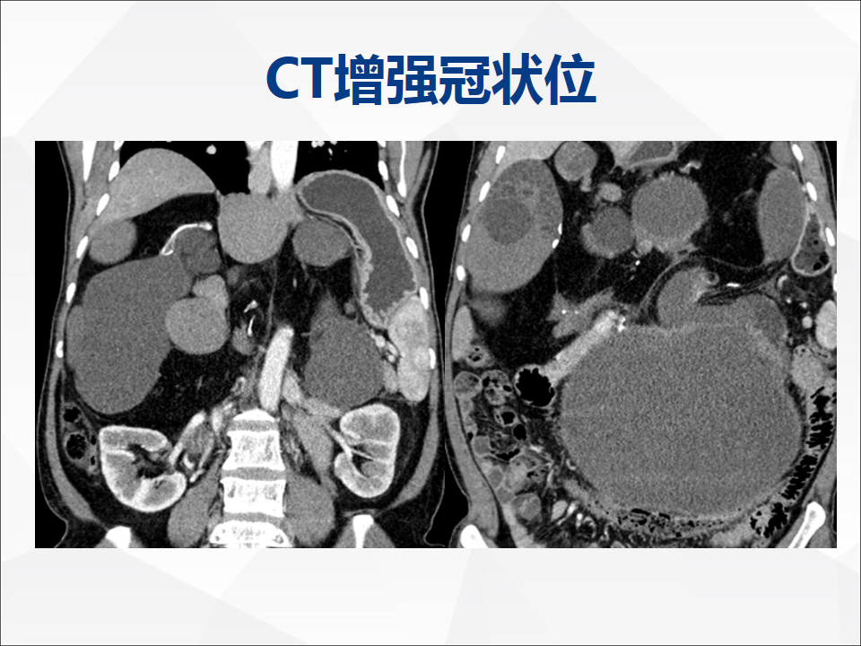 影像PPT - 【病例】腹腔成熟型畸胎瘤合并腹膜胶质瘤病1例CT-6