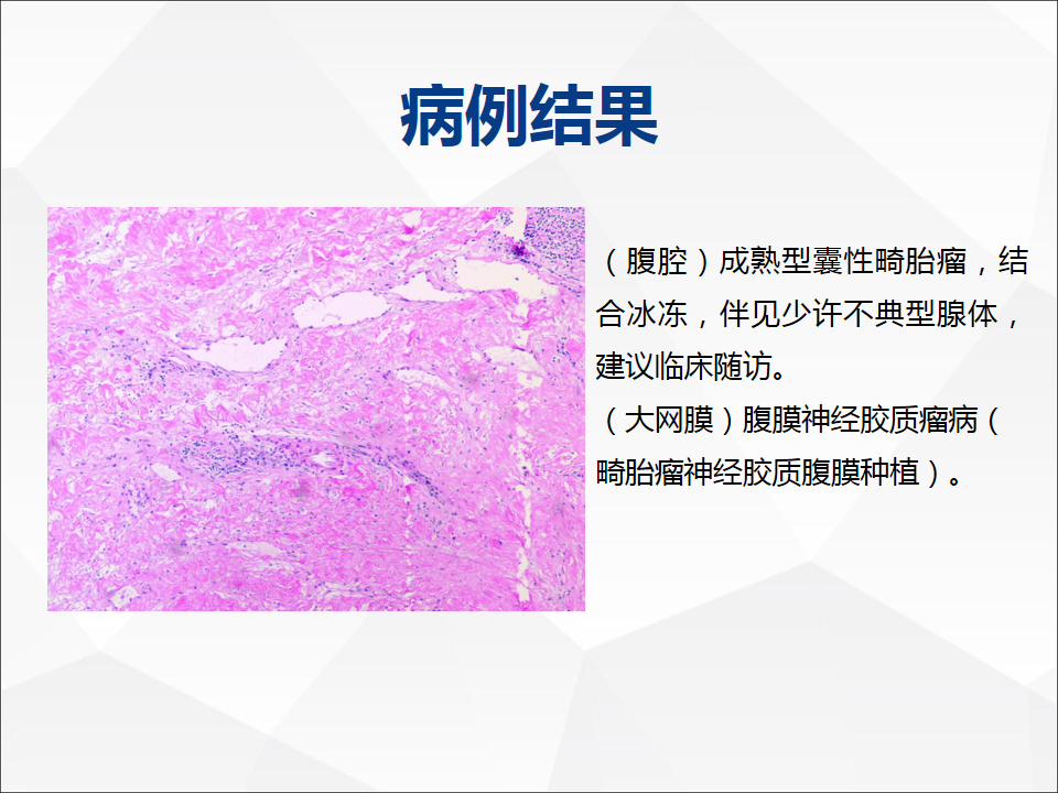 影像PPT - 【病例】腹腔成熟型畸胎瘤合并腹膜胶质瘤病1例CT-10