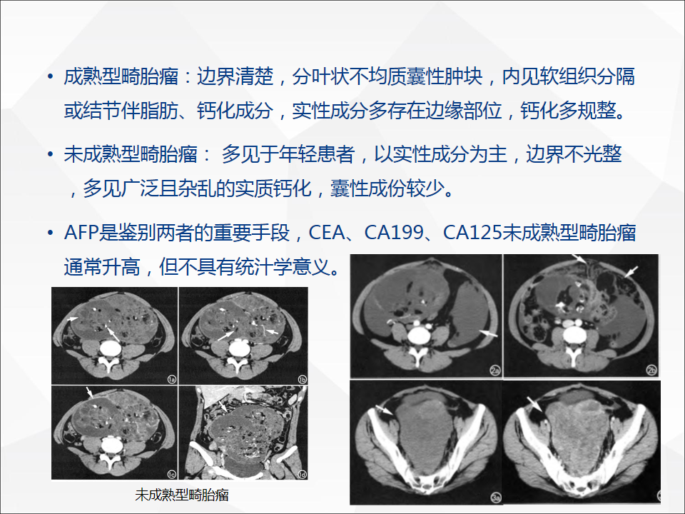 影像PPT - 【病例】腹腔成熟型畸胎瘤合并腹膜胶质瘤病1例CT-15