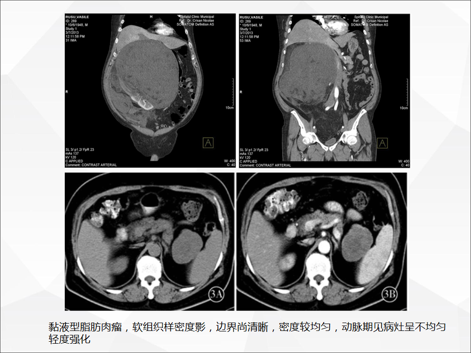 影像PPT - 【病例】腹腔成熟型畸胎瘤合并腹膜胶质瘤病1例CT-17