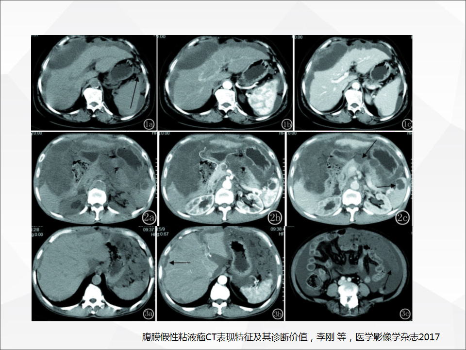 影像PPT - 【病例】腹腔成熟型畸胎瘤合并腹膜胶质瘤病1例CT-19