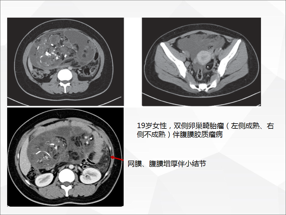 影像PPT - 【病例】腹腔成熟型畸胎瘤合并腹膜胶质瘤病1例CT-29