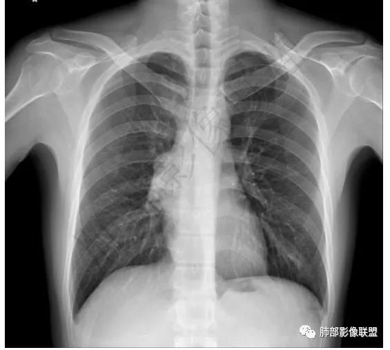 影像PPT - 【病例】前纵隔精原细胞瘤1例CT-3 影像PPT - 【病例】前纵隔精原细胞瘤1例CT-3