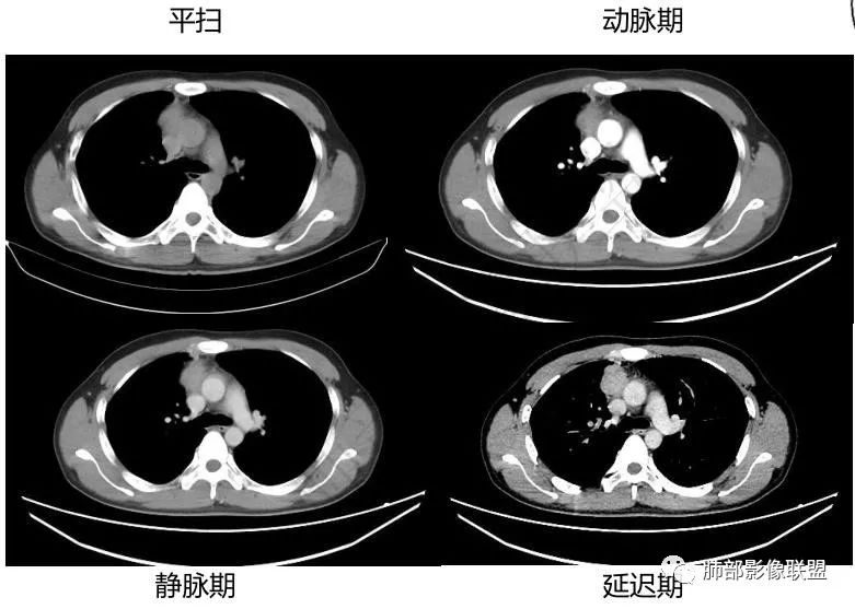 影像PPT - 【病例】前纵隔精原细胞瘤1例CT-5 影像PPT - 【病例】前纵隔精原细胞瘤1例CT-5