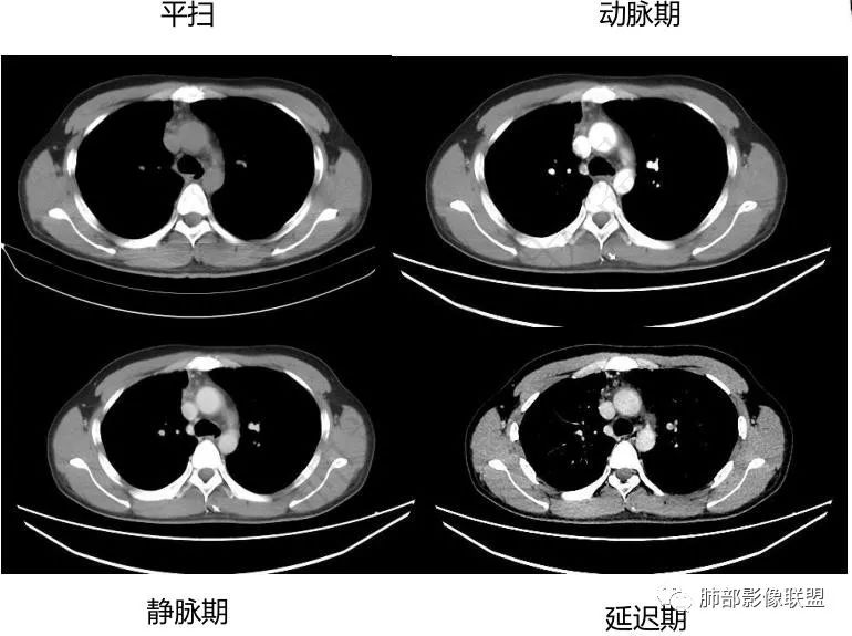 影像PPT - 【病例】前纵隔精原细胞瘤1例CT-4 影像PPT - 【病例】前纵隔精原细胞瘤1例CT-4