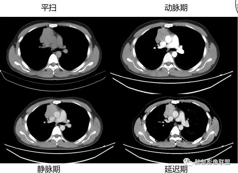 影像PPT - 【病例】前纵隔精原细胞瘤1例CT-6 影像PPT - 【病例】前纵隔精原细胞瘤1例CT-6