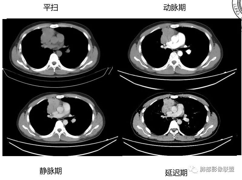 影像PPT - 【病例】前纵隔精原细胞瘤1例CT-7 影像PPT - 【病例】前纵隔精原细胞瘤1例CT-7