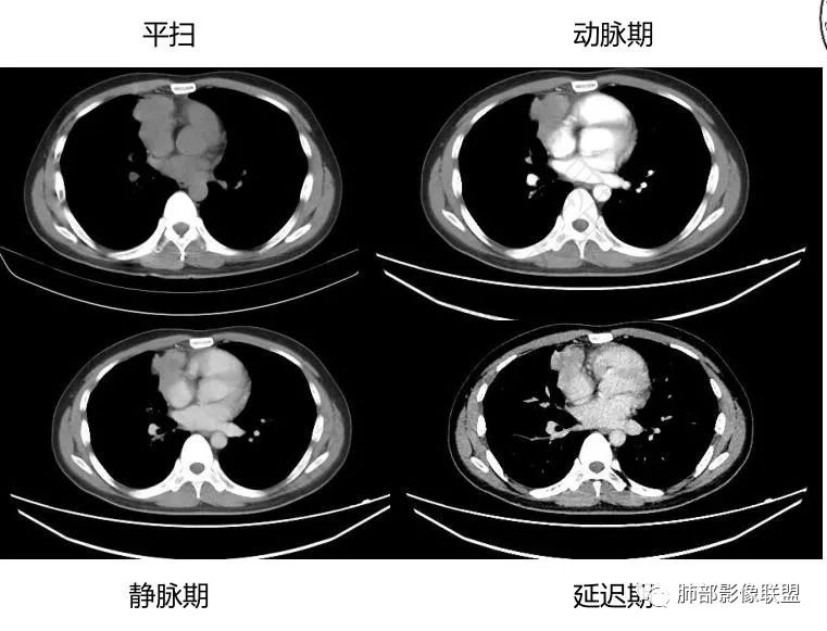 影像PPT - 【病例】前纵隔精原细胞瘤1例CT-9 影像PPT - 【病例】前纵隔精原细胞瘤1例CT-9
