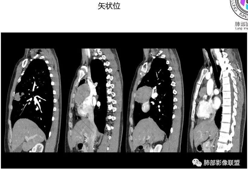 影像PPT - 【病例】前纵隔精原细胞瘤1例CT-12 影像PPT - 【病例】前纵隔精原细胞瘤1例CT-12