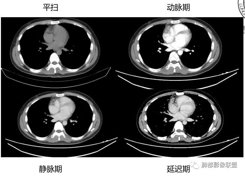 影像PPT - 【病例】前纵隔精原细胞瘤1例CT-10 影像PPT - 【病例】前纵隔精原细胞瘤1例CT-10